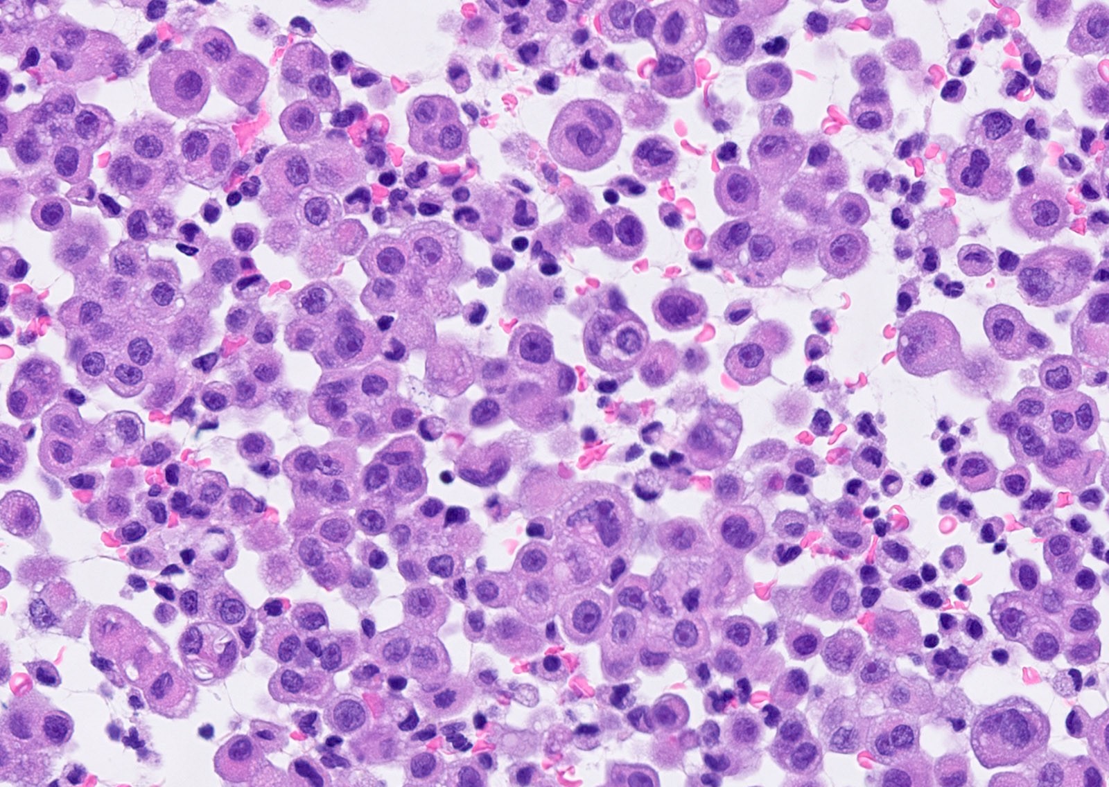 pleuramesotheliomabychkov02b