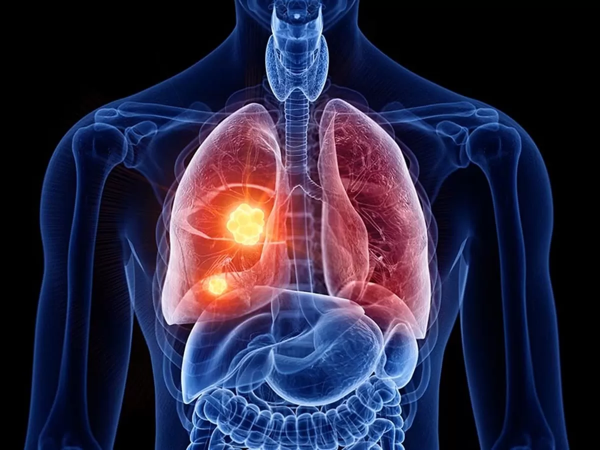 The Most Prevalent Type of Mesothelioma: Pleural